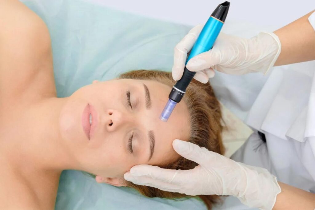 microneedling